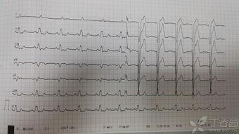 吃瓜齐鲁医院心电图,揭秘健康脉动